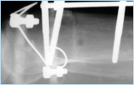 Latent phase for restoration of endosteal and periosteal blood vessels