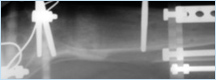 Consolidation phase- allows for intramembraneous ossification and recanalization of new bone