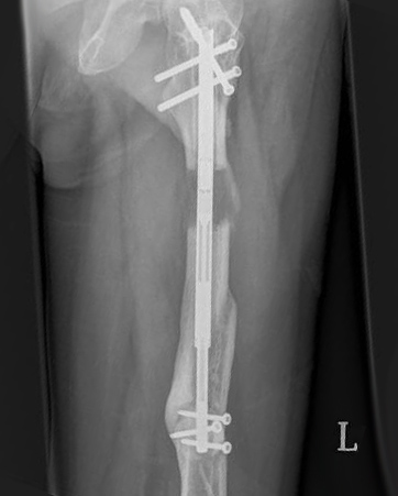 lengthening limb bone intramedullary surgery technology latest ellipse formation accelerating during