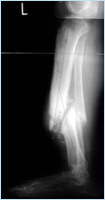 Non-healing fractures (Nonunions) and Malunions