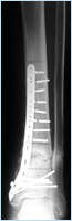 Bone infection (Osteomyelitis)