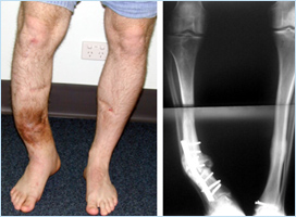 Post-traumatic bone deformities